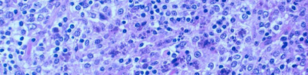 Depleción linfocitaria severa con inflamación granulomatosa del tejido linfoide. Presencia de cuerpos de inclusión intracitoplasmáticos.
