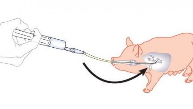 Esquema de lavado bronco-alveolar e raspagem bronquial
