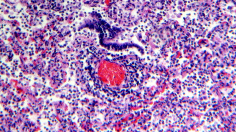 Figura 5. Infiltra&ccedil;&atilde;o linfocit&aacute;ria perivascular.
