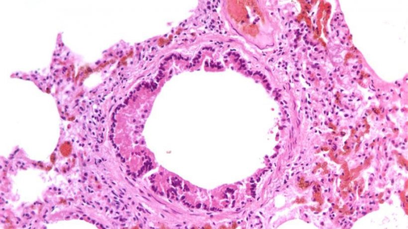 Figura 5: Bronquiolite necrotizante causada pela infecção por SIV
