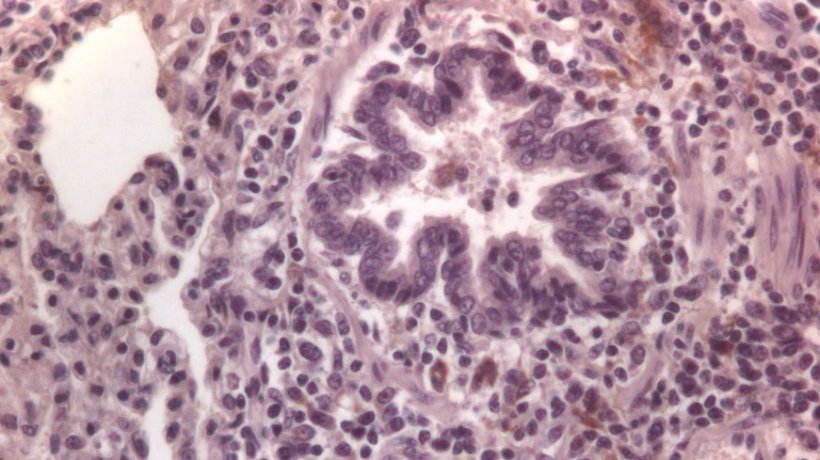 Figura 3: Células imunomarcadas contra PCV2 em pulmão
