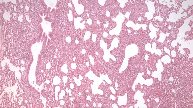 Figura 2: Pneumonia intersticial, caracterizada pelo engrossamento dos tabiques alveolares, numa infecção por PRRSV