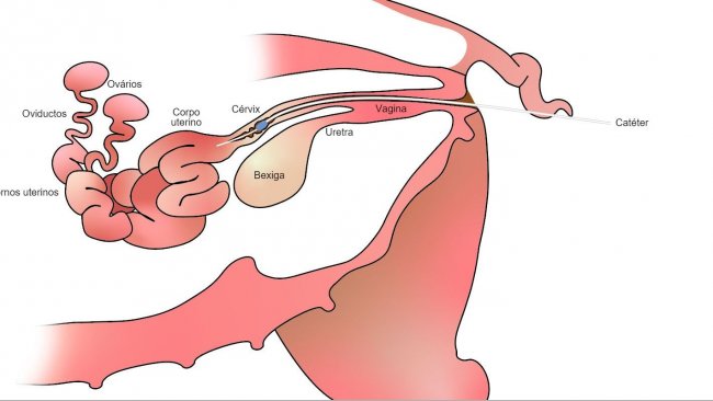 Imagem 1. Na inseminação artificial pós-cervical o sémen é depositado no corpo do útero, depois da cérvix
