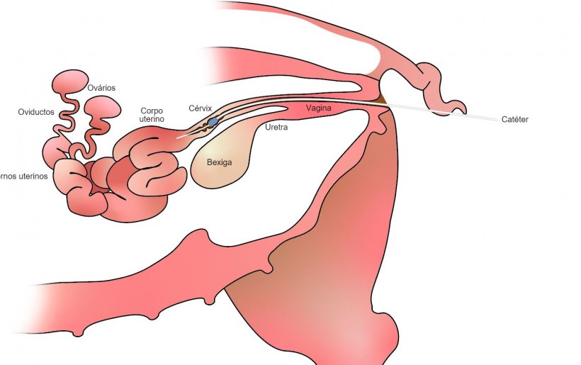 Imagem 1. Na inseminação artificial pós-cervical o sémen é depositado no corpo do útero, depois da cérvix
