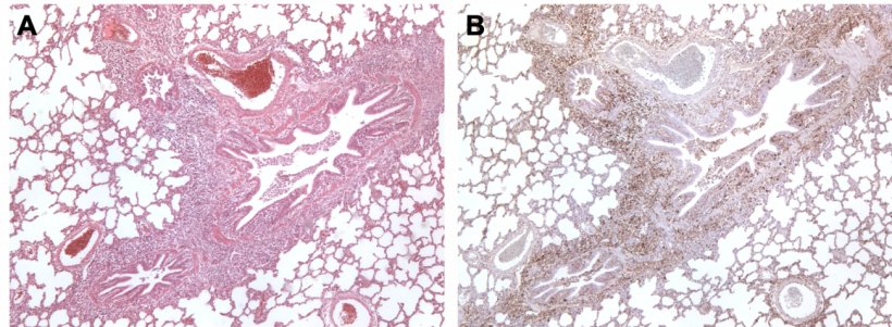 Figura 3. Pulmão de um porco co-infectado por M. hyopneumoniae e PCV2. A: Área de hiperplasia linfóide peribronquiolar causada por M. hyopneumoniae. B: Grande quantidade de antigénio de PCV2 nessa mesma área de hiperplasia linfóide.

