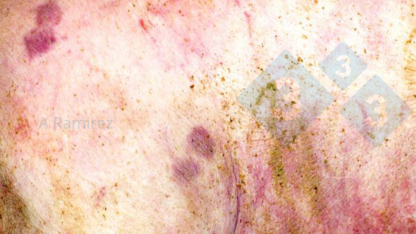 Figura 1. Les&atilde;o cut&acirc;nea patogn&oacute;mica em forma de diamante
