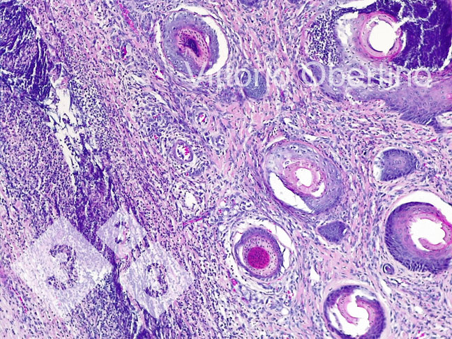Figura 8. Umbigo. Área dérmica localmente extendida que consta de fibroplasia com fibroblastos activados e numerosos vasos pequenos e imaturos (tecido de granulação recém formado), infiltrado inflamatorio multifocal com predominio de c&eacute;lulas linfoplasmacelulares; em algumas estruturas vasculares existe um infiltrado inflamatório granuloc&iacute;tico que rodeia a parede do vaso e a infiltra focalmente (vasculitis leucotariana).
