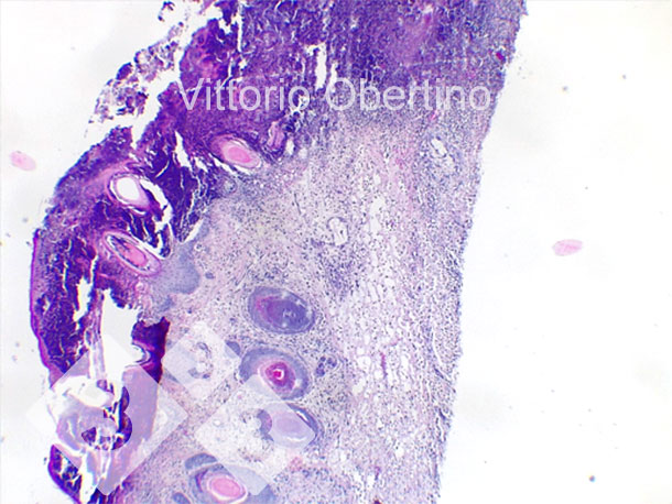 Figura 9. Pele. Erosão epitelial focal em que a camada superficial é substituída por abundante material eosinof&iacute;lico amorfo a granular com restos carior&eacute;cticos (necrose) e abundantes granulocitos neutrof&iacute;licos degenerados e viáveis. Multifocalmente, o epitélio aparece de moderada a marcadamente hiperpl&aacute;sico com hiperqueratose ortoquerat&oacute;sica de moderada a severa. Também é observada a presença multifocal de crosta. A derme aparece difusa e moderadamente fibr&oacute;tica.
