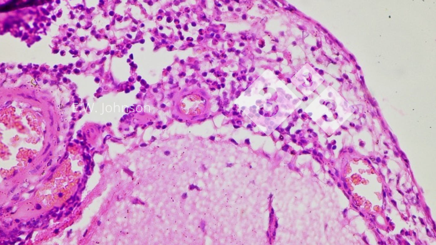 <p>Imagem 3. Meningite com células mononucleares e algumas células polimorfonucleares. Cérebro.</p>