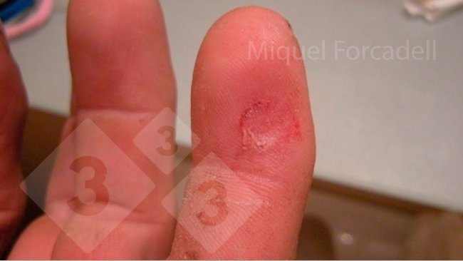 Os pequenos e afiados caninos dos leit&otilde;es podem provocar estas feridas nos dedos dos trabalhadores durante a opera&ccedil;&atilde;o de desbaste dos dentes.
