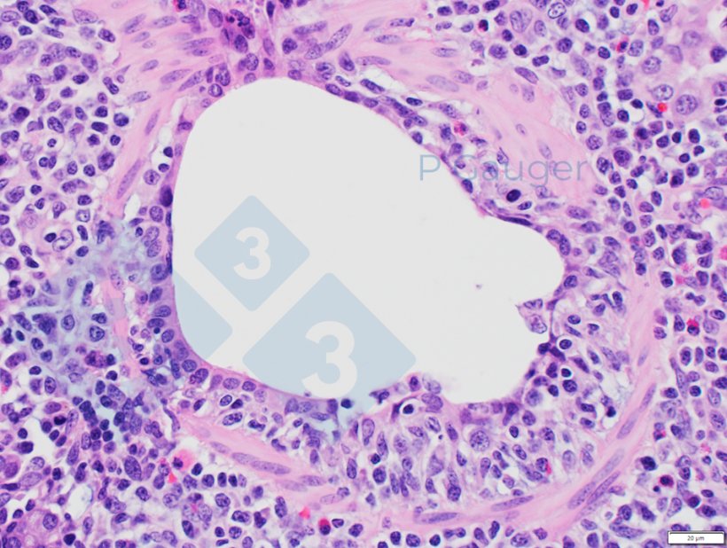 Figura 4: Histopatologia pulmonar que mostra adelgaçamento do epitélio bronquiolar, que é um exemplo de necrose.&nbsp;(Fonte da foto: Phil Gauger ISUVDL)
