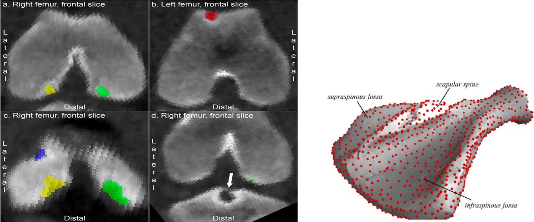 Figura 5. Direita: Vistas frontal e lateral das cabe&ccedil;as femorais mostrando les&otilde;es na superf&iacute;cie articular. Esquerda: Imagem tridimensional da omoplata.