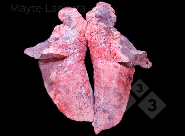 Processo broncopneum&oacute;nico
