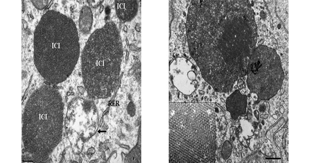 Microscopía electrónica de un ganglio linfático de un cerdo con PCV2-SD. Nótese la presencia de cuerpos de inclusión intracitoplasmáticos con PCV2 (ICI); en algunas zonas, las partículas virales pueden disponerse en estruturas paracristalinas  (recuadro de la imagen derecha)