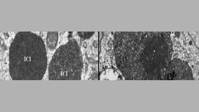 Microscopía electrónica de un ganglio linfático de un cerdo con PCV2-SD