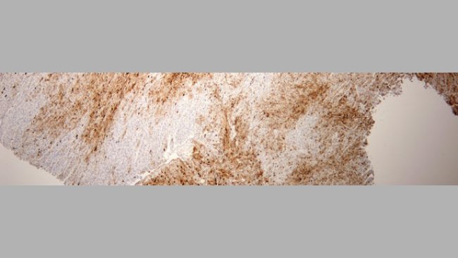 severe myocardial damage due to PCV2