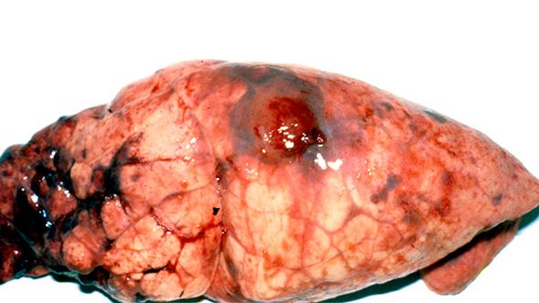 Lesiones de App cr&oacute;nica en el l&oacute;bulo diafragm&aacute;tico con ac&uacute;mulos de fibrina.