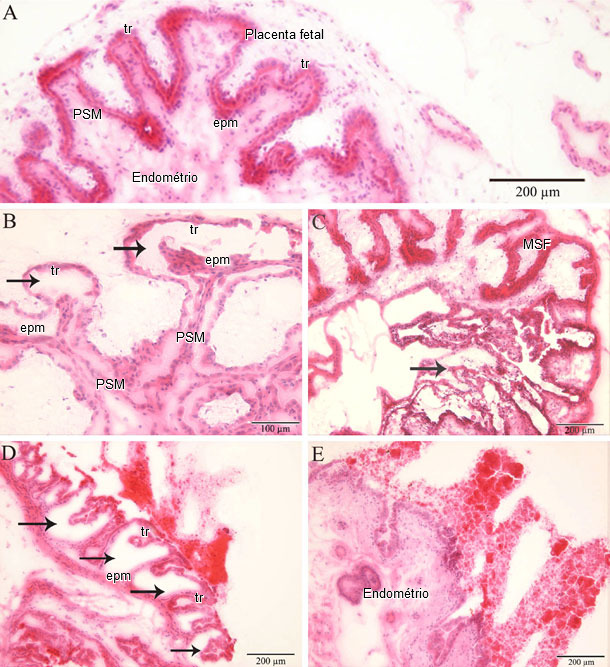 Histopatología en endometrio y planceta