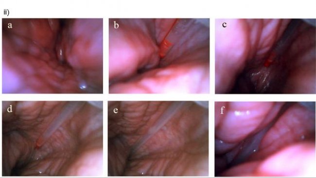 Inseminación post-cervical vista desde el interior del útero