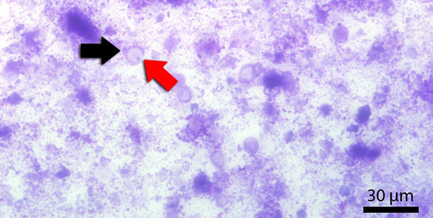 Frotis fecal teñido con Diff-Quick. La flecha roja señala la vacuola central y la negra el núcleo.