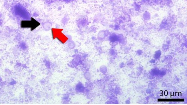 Frotis fecal teñido con Diff-Quick. La flecha roja señala la vacuola central y la negra el núcleo.