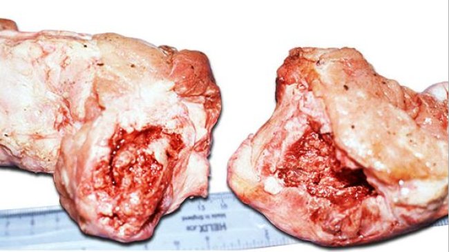 Cabeza del fémur completamente fracturada por la epífisis o debajo de ella mostrando hinchazón alrededor de la fractura debido a periostitis